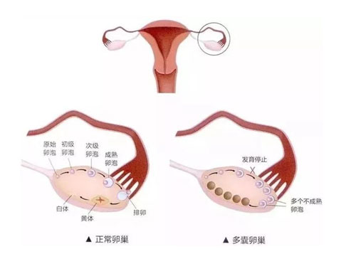 多囊样改变是什么意思？两侧卵巢增大，有很多小卵泡！