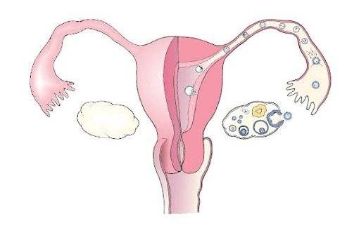 子宫出血会引起卵巢早衰吗？月经量特少是什么原因呢？